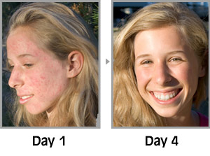 Clarisonic Mia 2 Acne Skin Cleansing System | How To Get Rid Of Acne